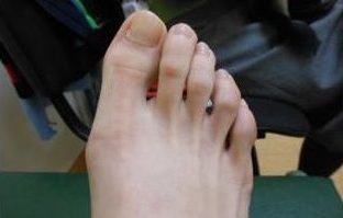 Profilaktyka i Leczenie Haluksów u dzieci i młodzieży